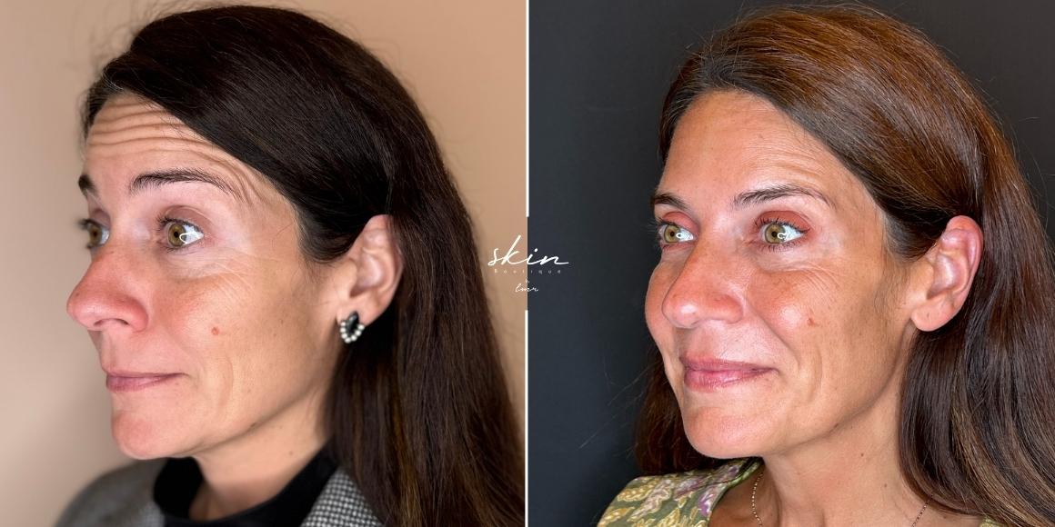 Tratamento de rugas e flacidez com Botox e Bioestimuladores de Colagénio #6644