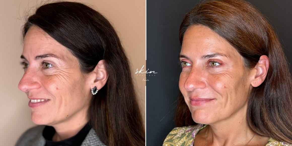 Tratamento de rugas e flacidez com Botox e Bioestimuladores de Colagénio #6644