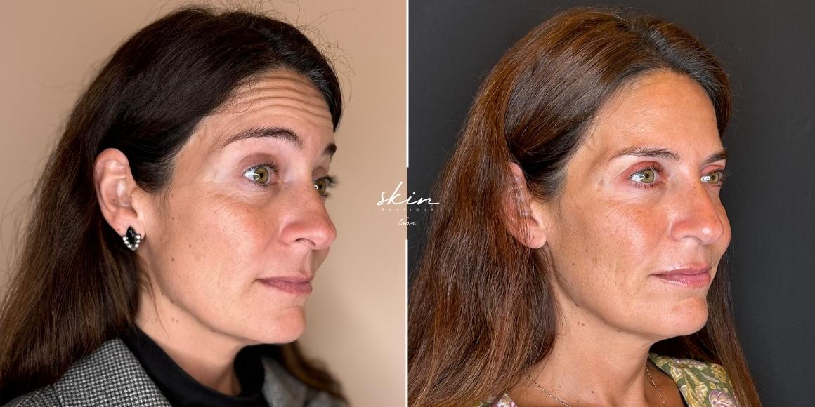 Tratamento de rugas e flacidez com Botox e Bioestimuladores de Colagénio #6644