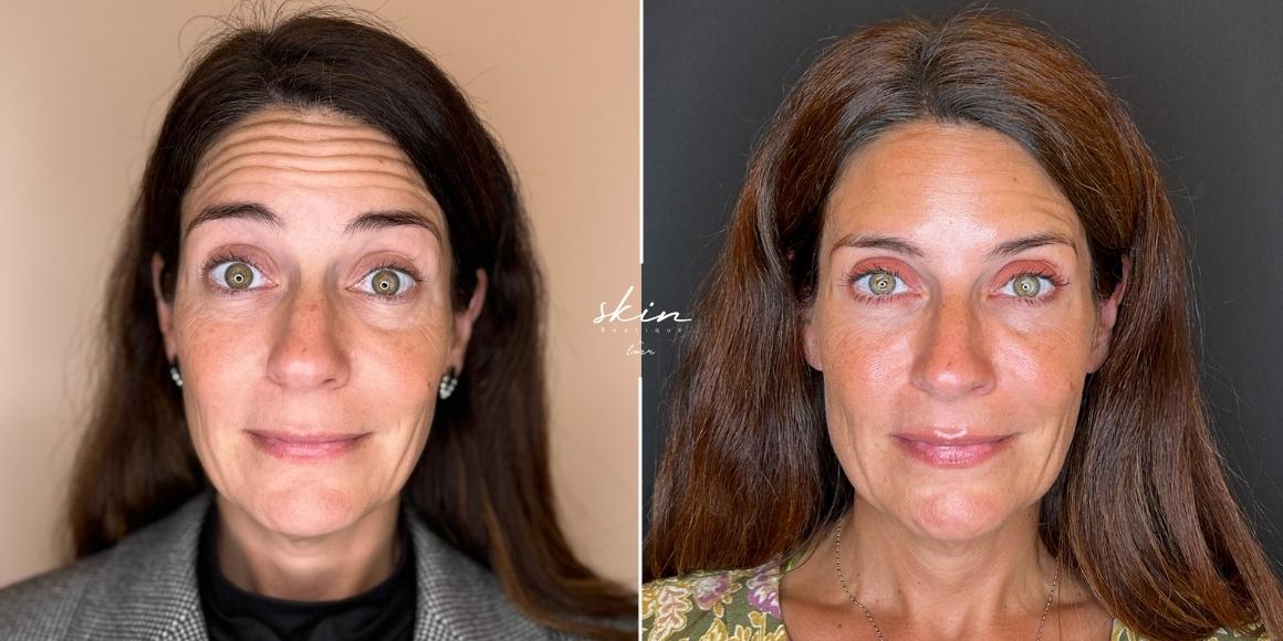 Tratamento de rugas e flacidez com Botox e Bioestimuladores de Colagénio #6644