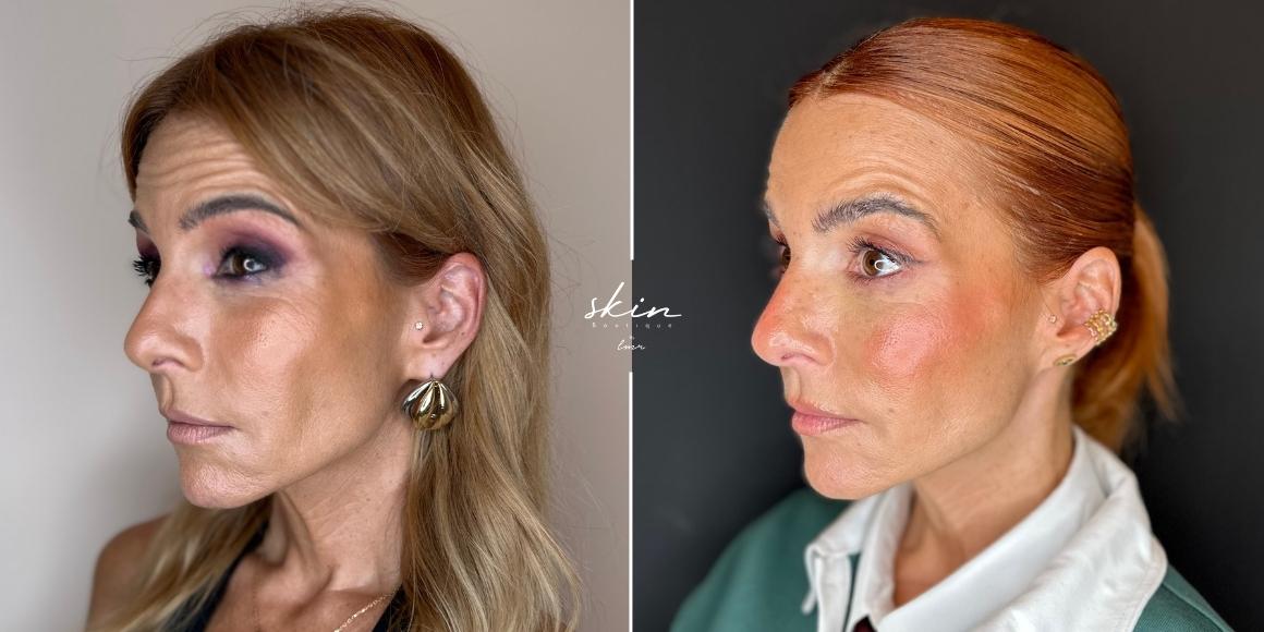 Tratamento de rugas e qualidade da pele com Botox e Microagulhamento #18621