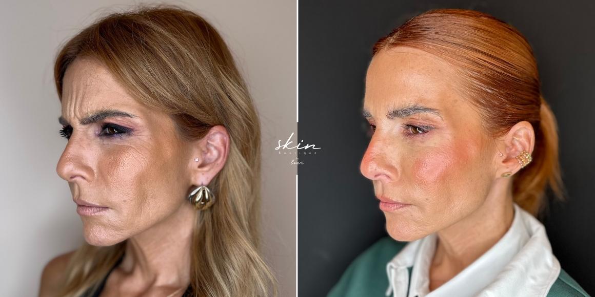 Tratamento de rugas e qualidade da pele com Botox e Microagulhamento #18621