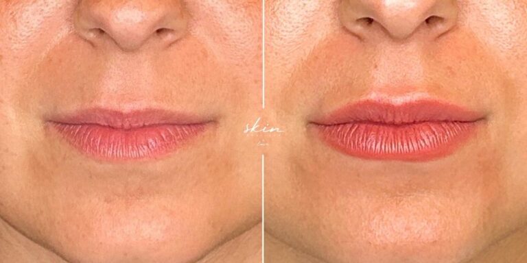 Lip fillers with hyaluronic acid