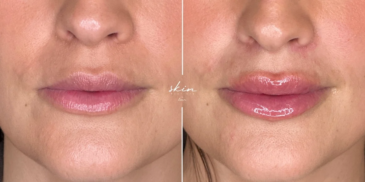 Preenchimento labial com ácido hialurónico #9455