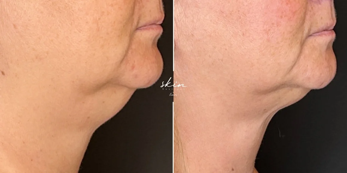 Tratamento da papada com Coolsculpting e Exilis #37167