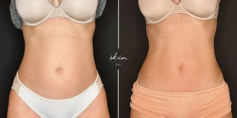 Treatment of localized fat in the abdomen #32852