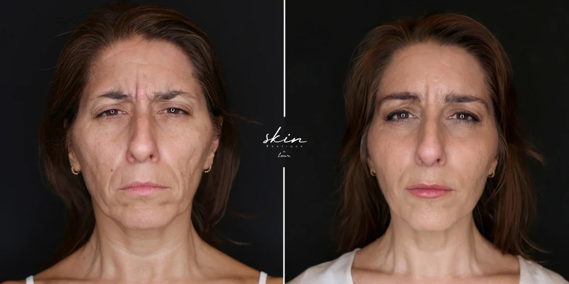 Facial Harmonization #52063