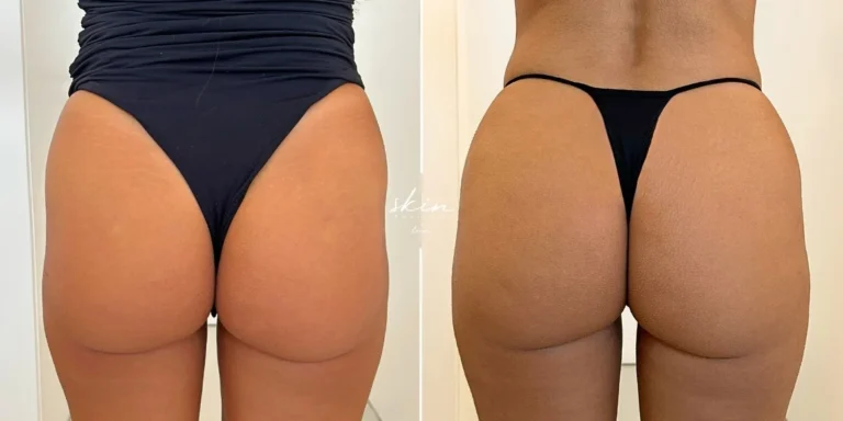Filling the hip dip with hyaluronic acid #33657