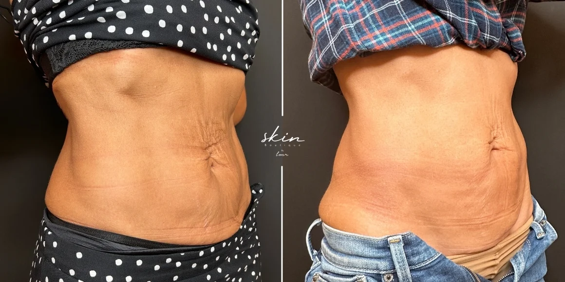 Tratamento de flacidez abdominal com Ultraformer MPT e Bioestimuladores de Colagénio #41693