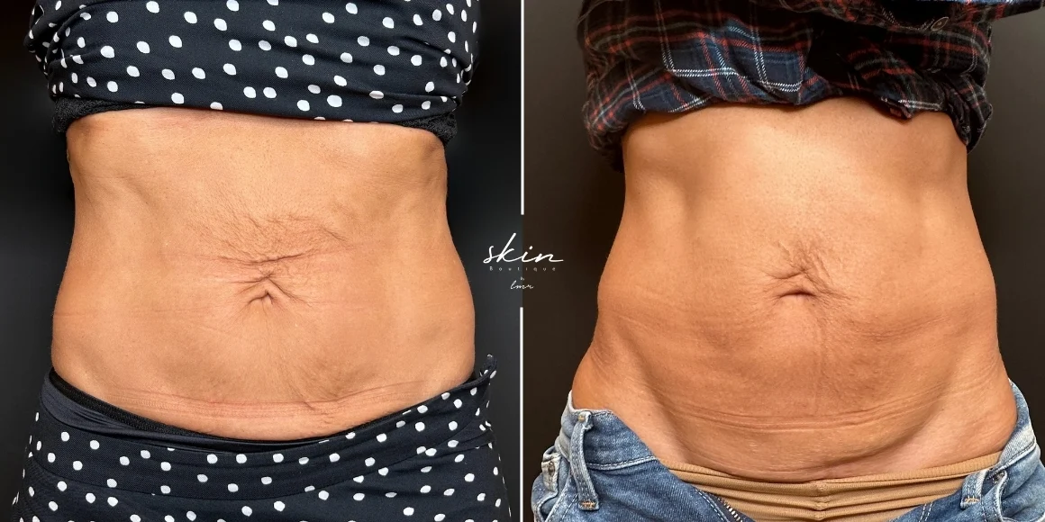 Tratamento de flacidez abdominal com Ultraformer MPT e Bioestimuladores de Colagénio #41693