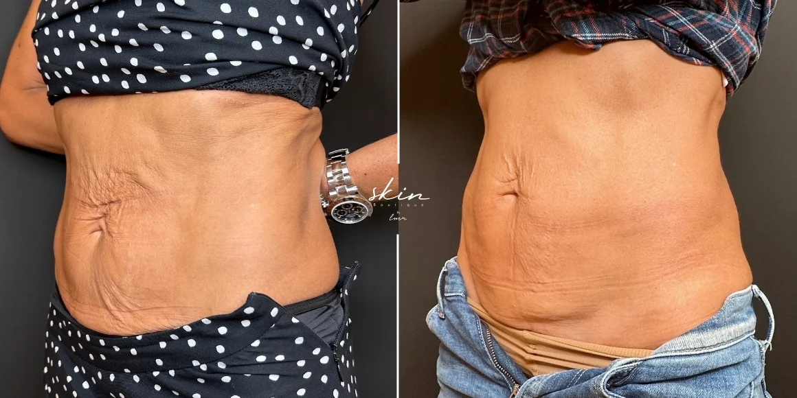 Tratamento de flacidez abdominal com Ultraformer MPT e Bioestimuladores de Colagénio #41693