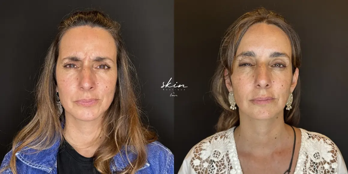 Tratamento de rugas com botox #54978