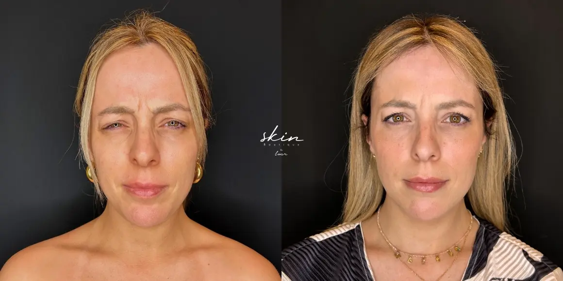 Tratamento de rugas com botox #41092