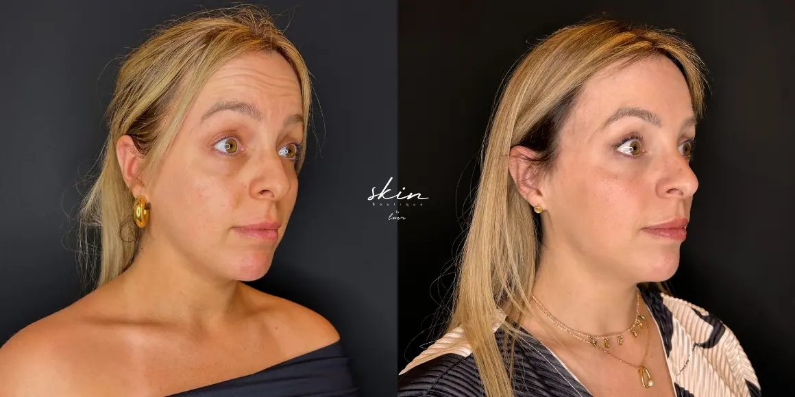 Tratamento de rugas com botox #41092