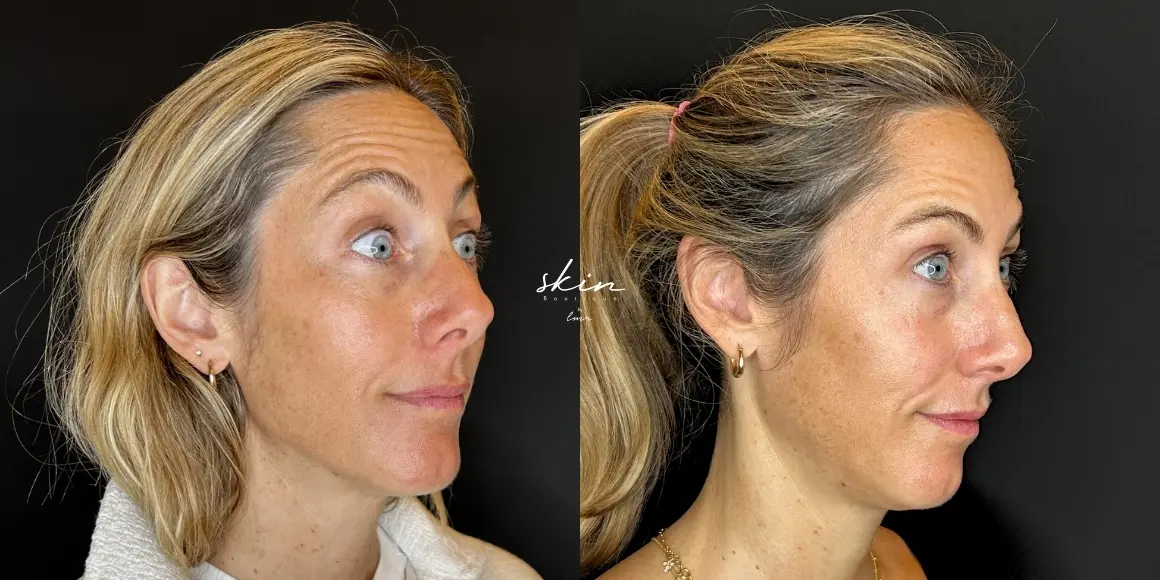 Tratamento de rugas com botox #45210
