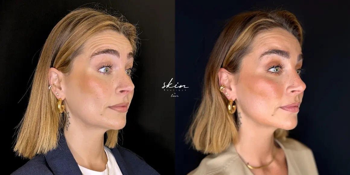 Tratamento de rugas com botox #52134