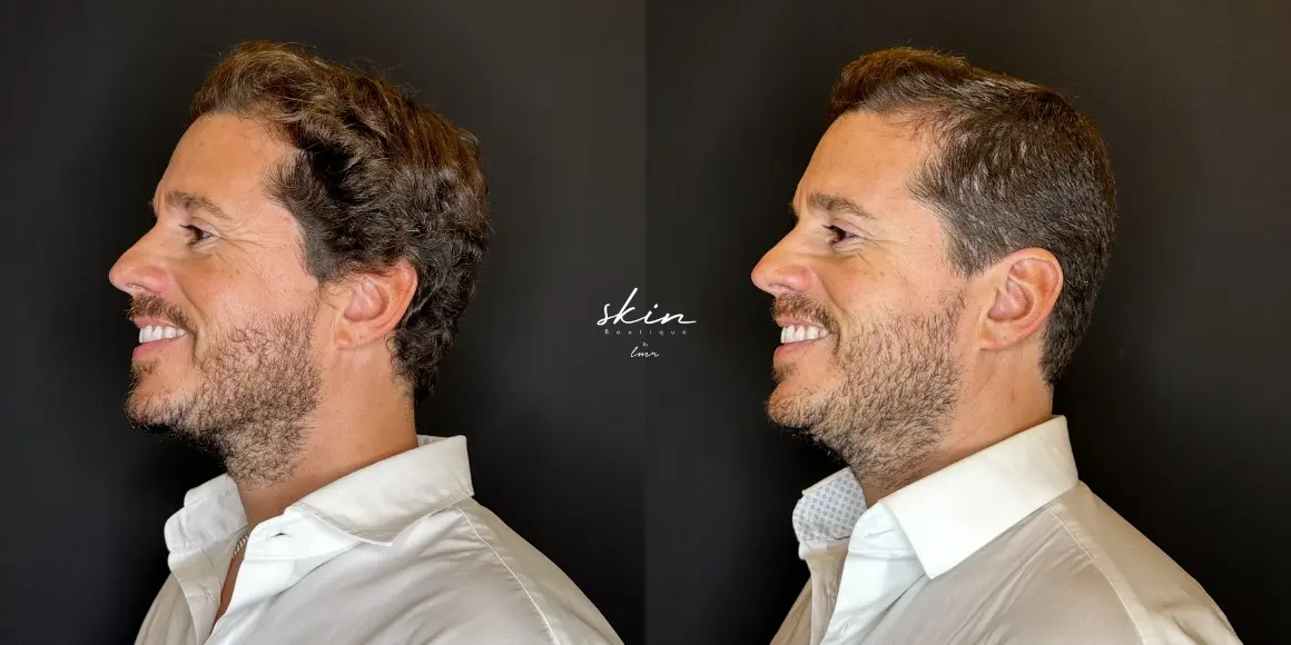 Tratamento de rugas com botox #50803