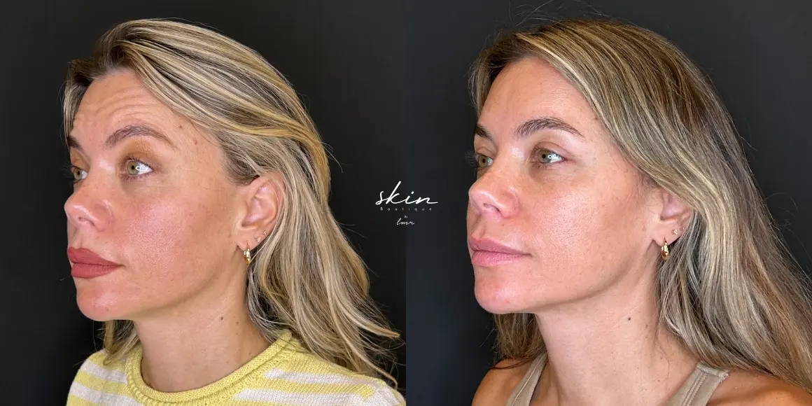 Tratamento de rugas com botox #26372