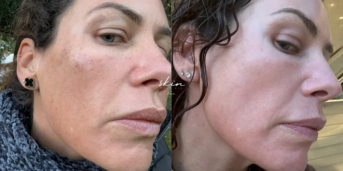 Tratamento Laser Nordlys manchas