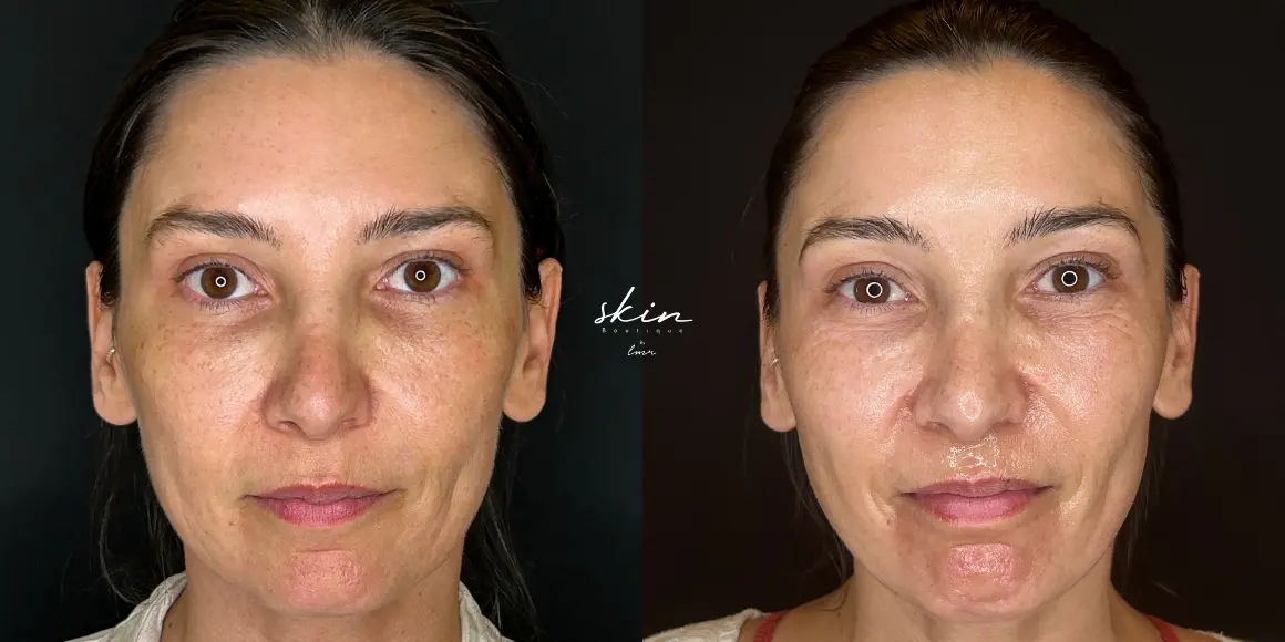 laser nordlys skin boutique